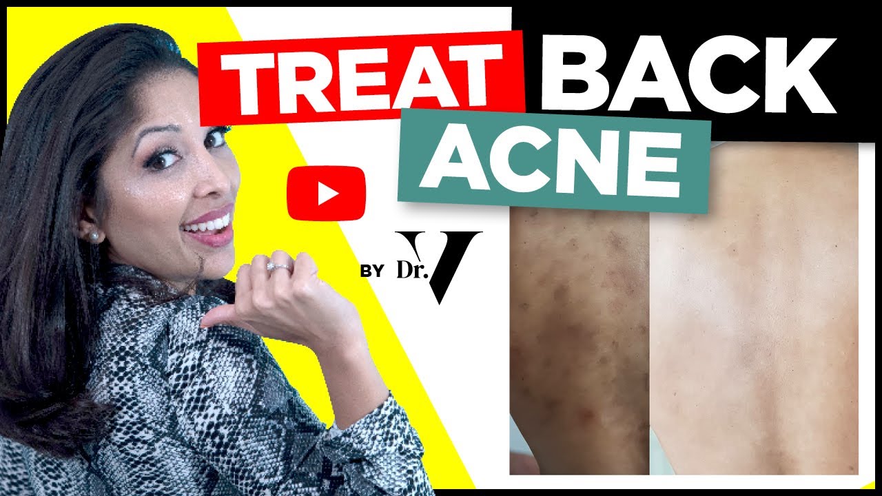 How To Treat Back Acne FAST | Doctors Tips | Skin of Colour Asian/Black | Treat Backne | DR V