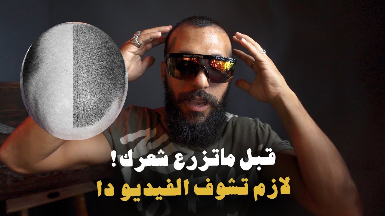 قبل زراعة الشعر شوف الفيديو دا