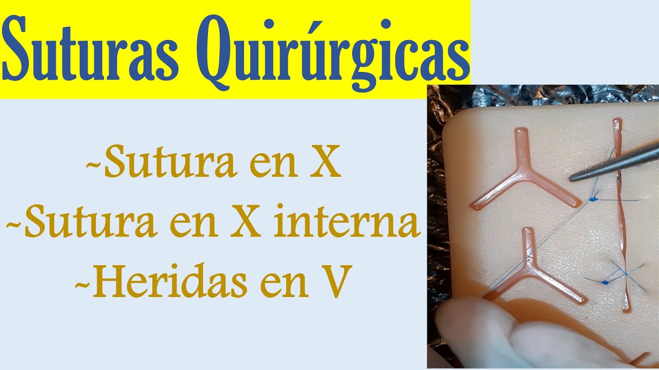 SUTURA EN X, SUTURA EN X INTERNA Y SUTURA PARA HERIDAS EN V