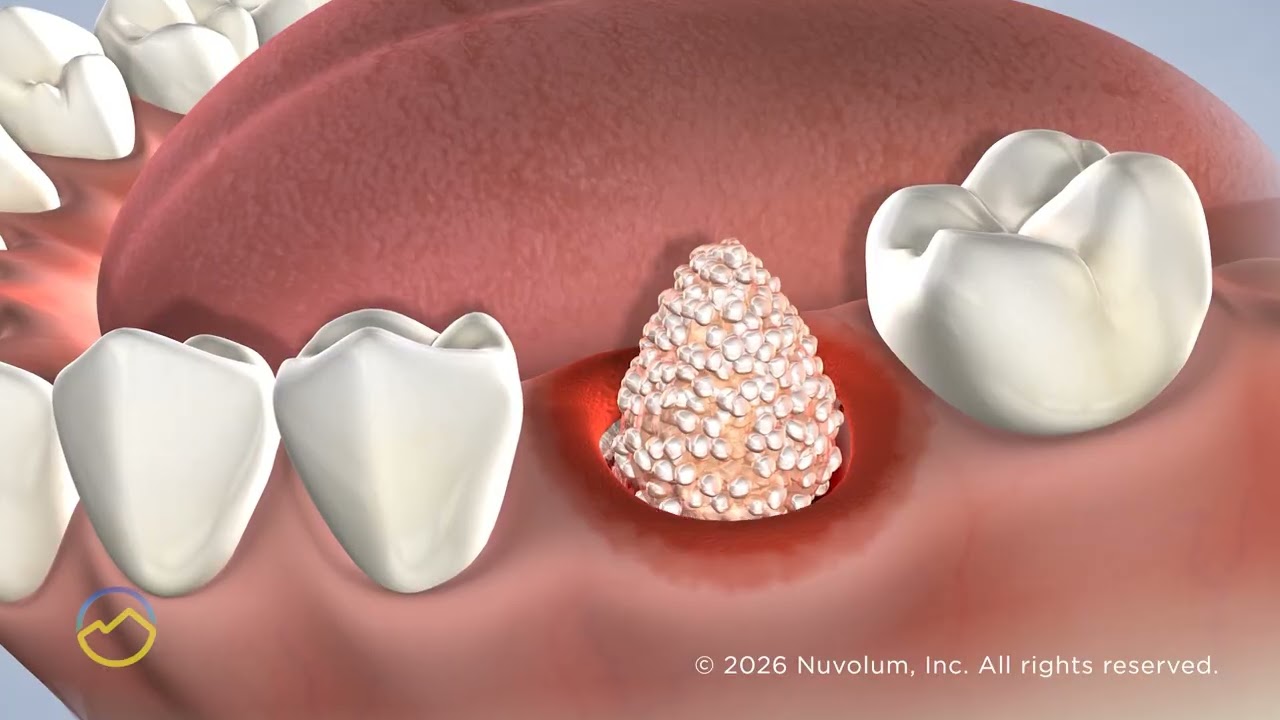 Bone Grafting in El Dorado Hills, CA