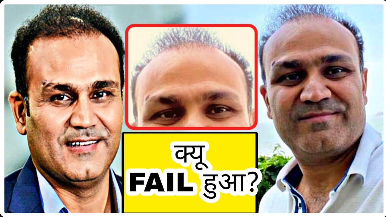 VIRENDRA SEHWAG का HAIR TRANSPLANT आखिर क्यू FAIL हुआ? FULL EXPLANATION