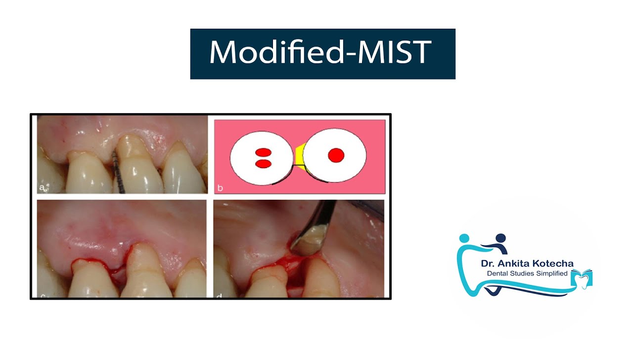 Modified MIST| MINIMALLY INVASIVE PERIODONTAL SURGICAL TECHNIQUES| DR. ANKITA KOTECHA