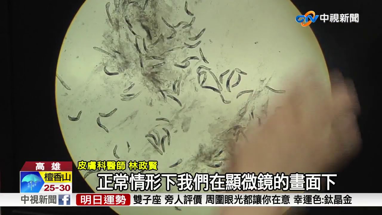天氣熱臉頰過敏爛痘惡化　小心蟲蟲危機！