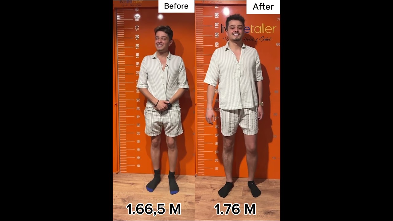 Before and after +9.5 cm more height #limblengthening #beforeafter #ozkansagin #gettaller #shorts