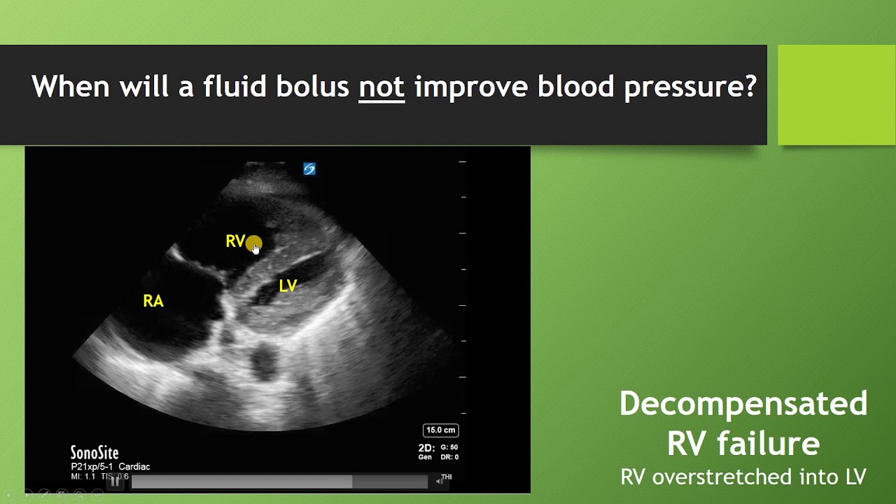 Managing Hypotension in the Rapid Response Patient