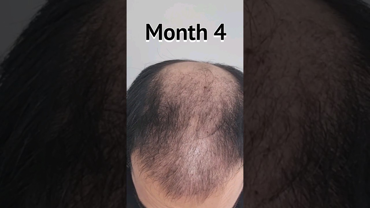FUE Hair Transplant Timeline | Day 1 to Day 365 | Before & After | 6100 Grafts #hairtransplant