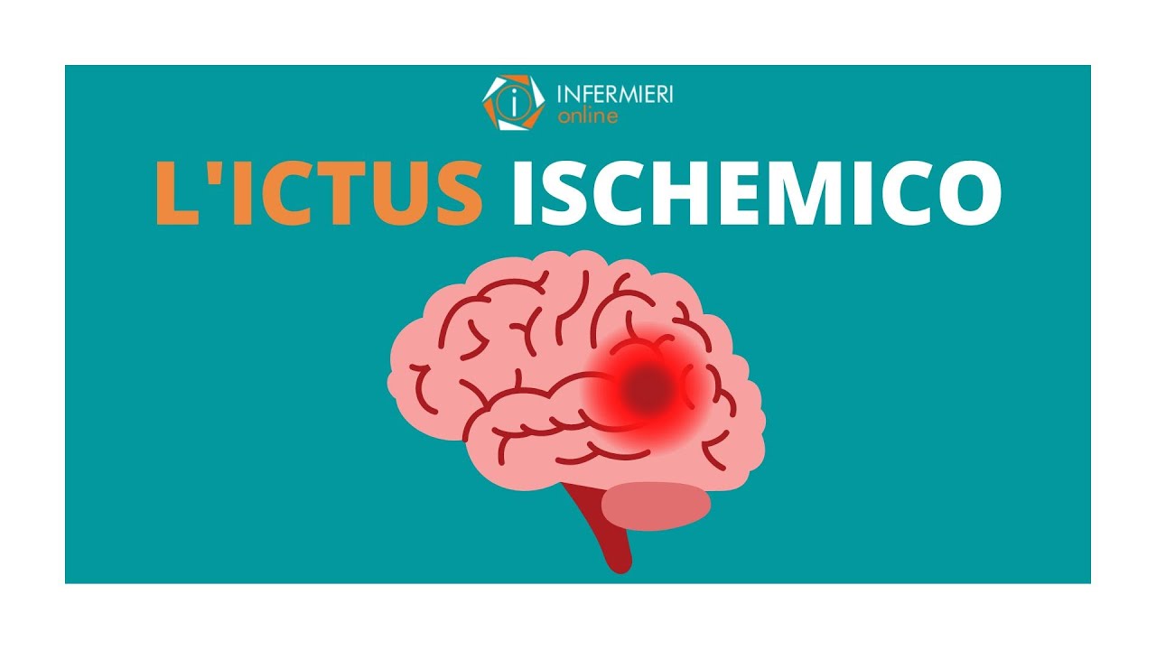L'ICTUS ISCHEMICO | STROKE | INFERMIERI Online