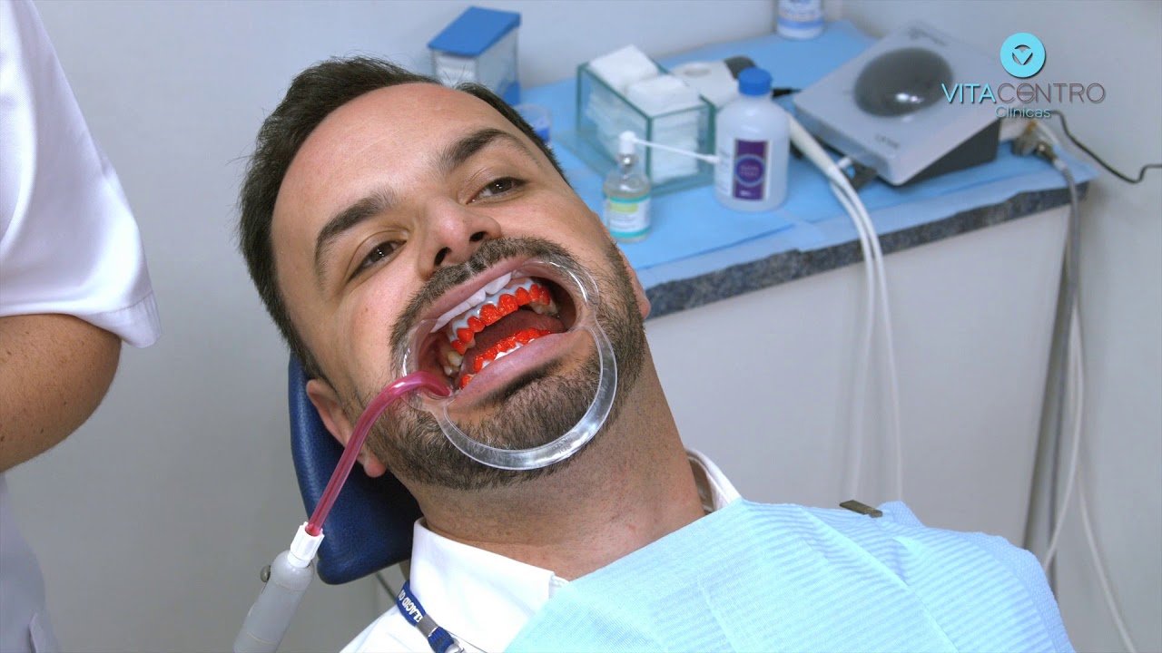 Branqueamento dentário