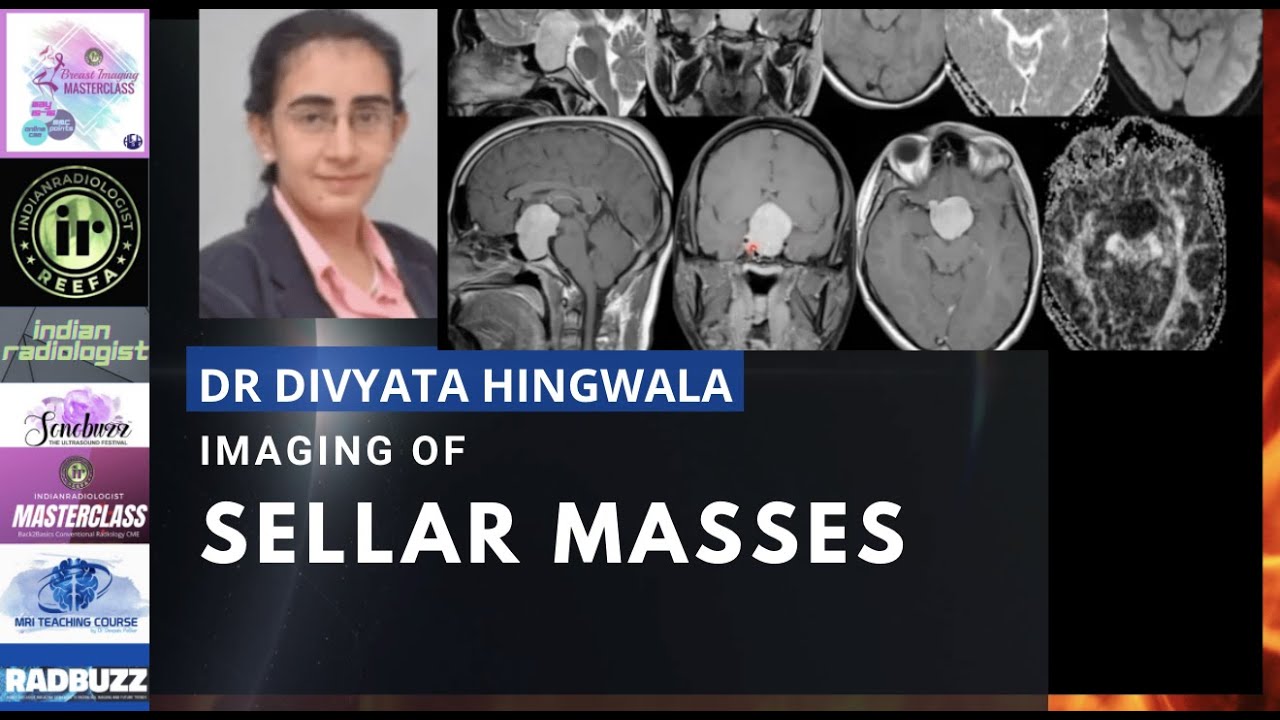 IMAGING OF SELLAR MASSES | DR DIVYATA HINGWALA | MRI TEACHING COURSE | PITUITARY MICROADENOMA
