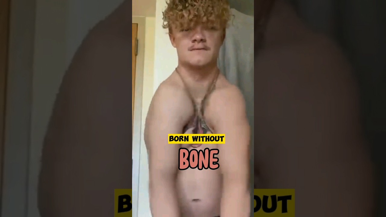 Born without Bones #shorts #bones