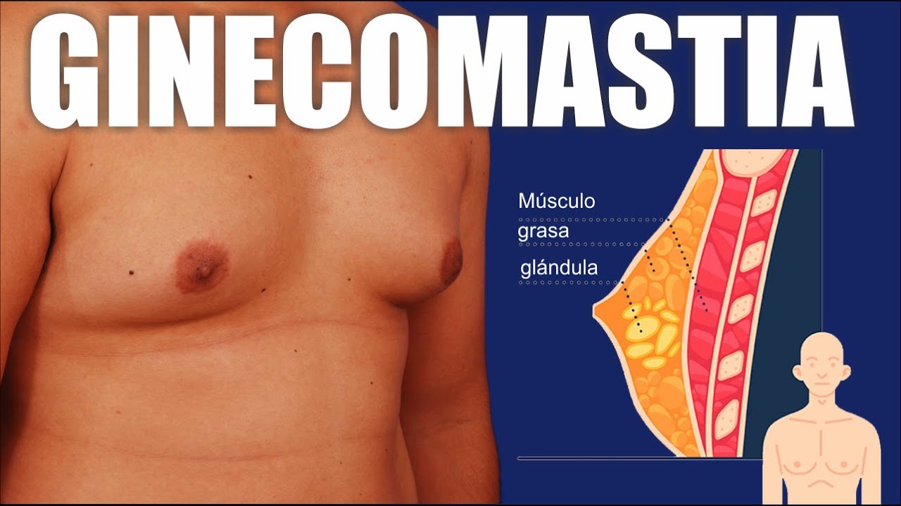 CIRUG&Iacute;A de GINECOMASTIA y PSEUDOGINECOMASTIA 👱🏻&zwj;♂️🧑🏻 Pechos abultados 🎩 Dr ALBERTO CALVO QUIROZ