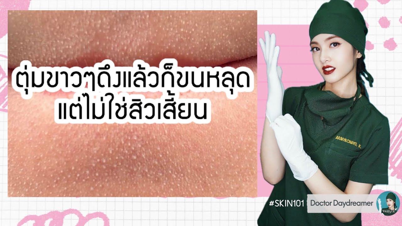 เครียดมาก😰ตุ่มขาวๆ👌🏻ดึงแล้วก็ขนหลุดแต่ไม่ใช่ #สิวเสี้ยน | DOCTOR DAYDREAMER  #SKIN101 ep.37
