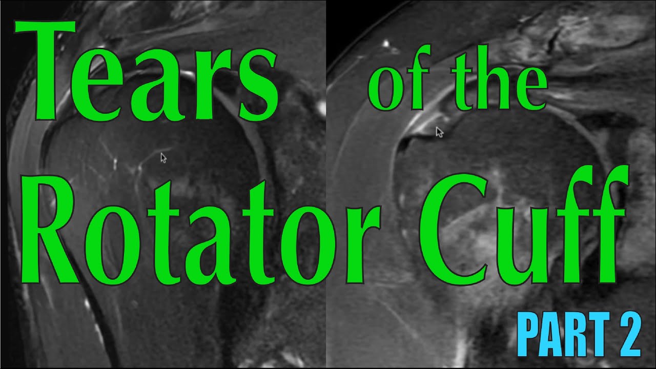 Tears of the Rotator Cuff Part 2: Identifying Tears on MRI