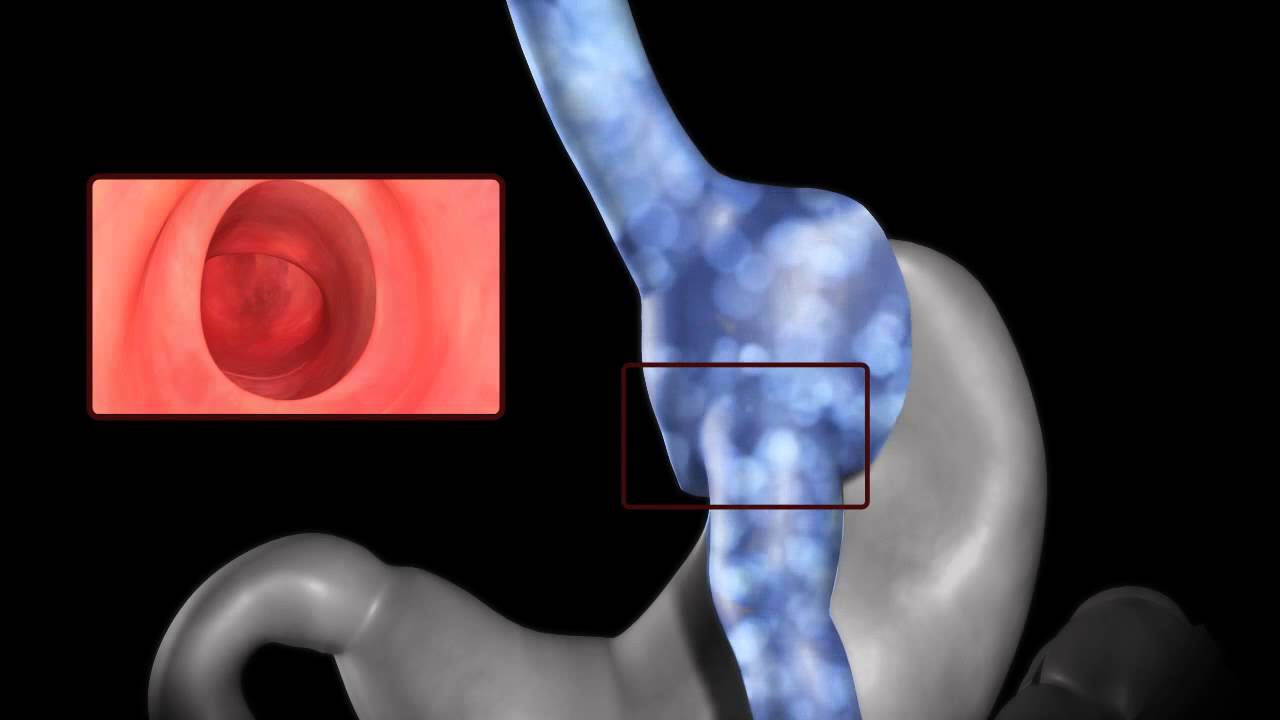 Apollo Overstitch İle Başarısız Gastrik Bypass Revizyonu - Animasyon