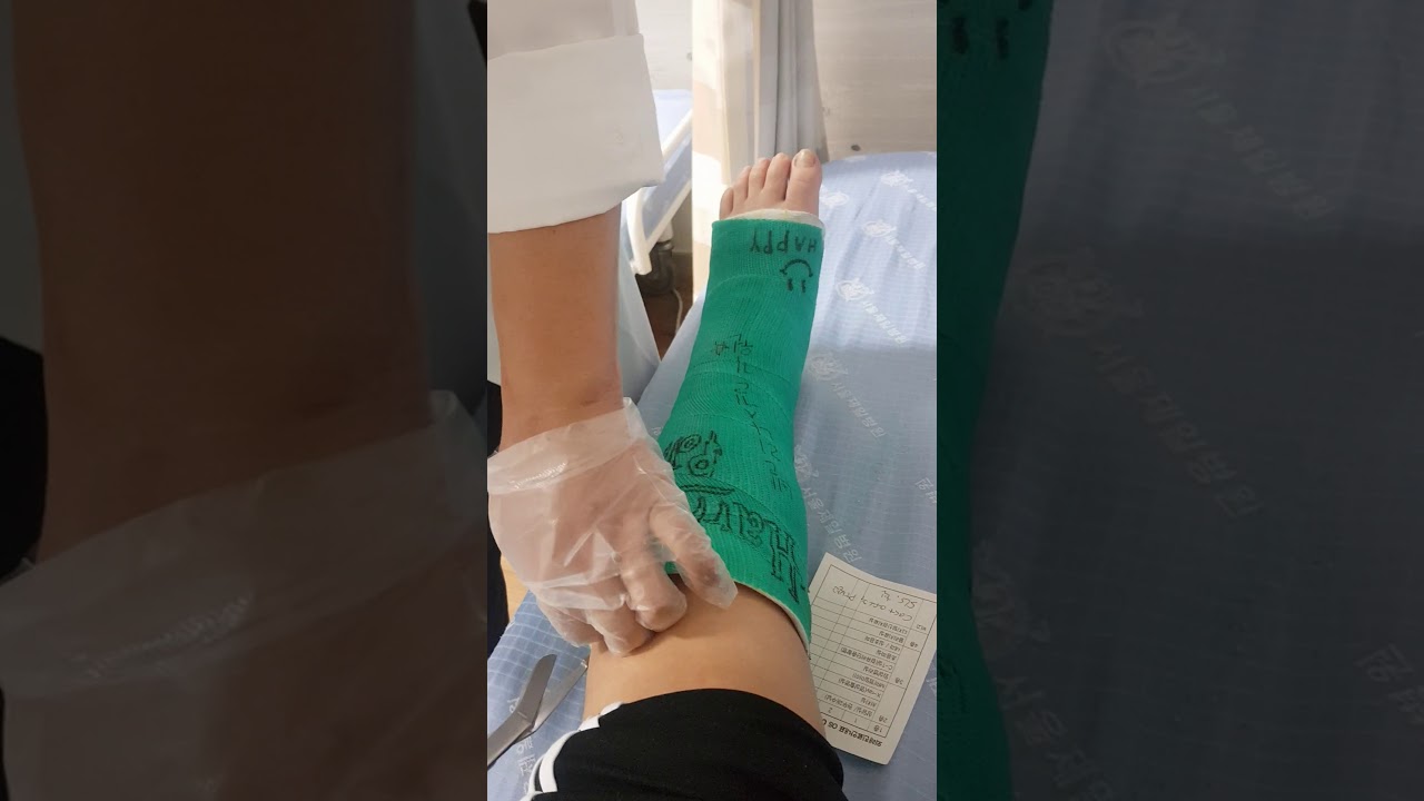 같은다리 1년만에 수술하고 통깁스 절단 2 (2020년)
