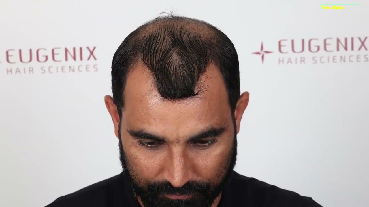 Mohammed Shami's Hair Transplant Journey - Full details