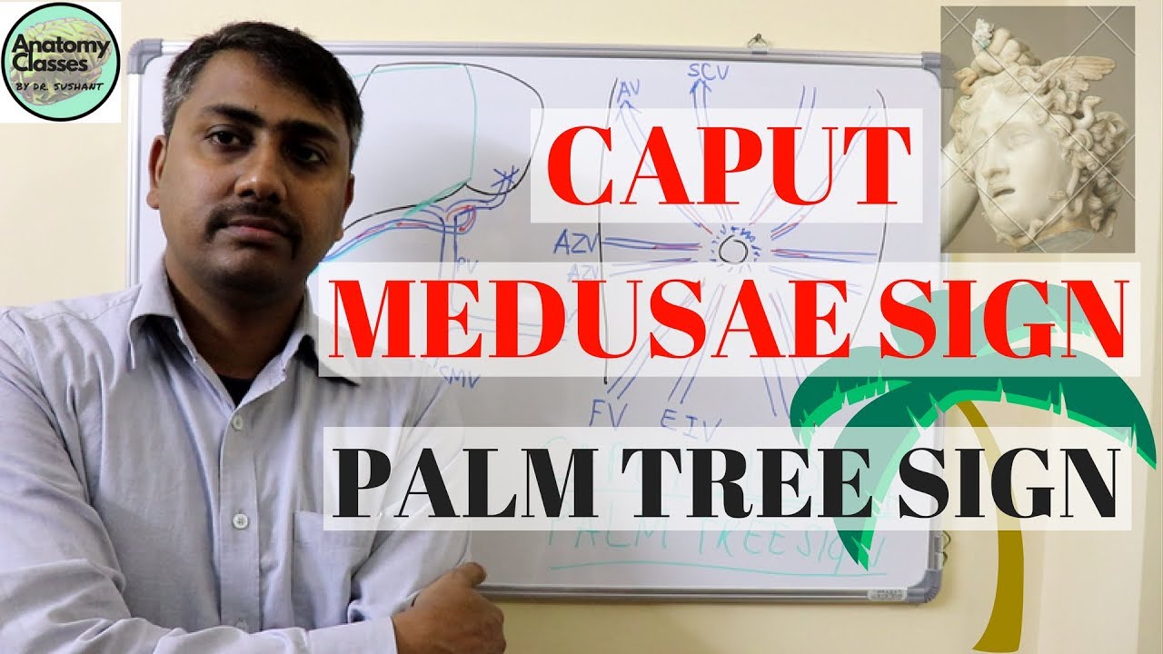 Caput Medusae