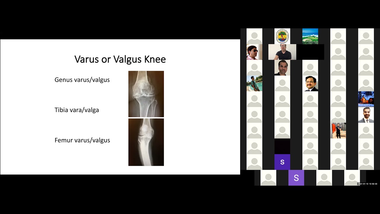 Choosing Alignment Philosophy for Total Knee  Replacement By Emmanuel Theinpont