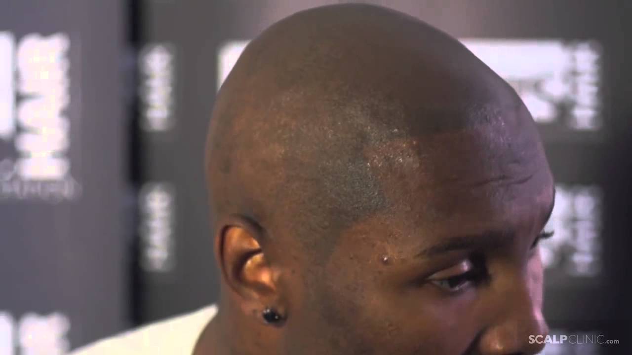 Best Hair Loss Solution for Black Males - Scalp Micropigmentation at Scalp Clinic