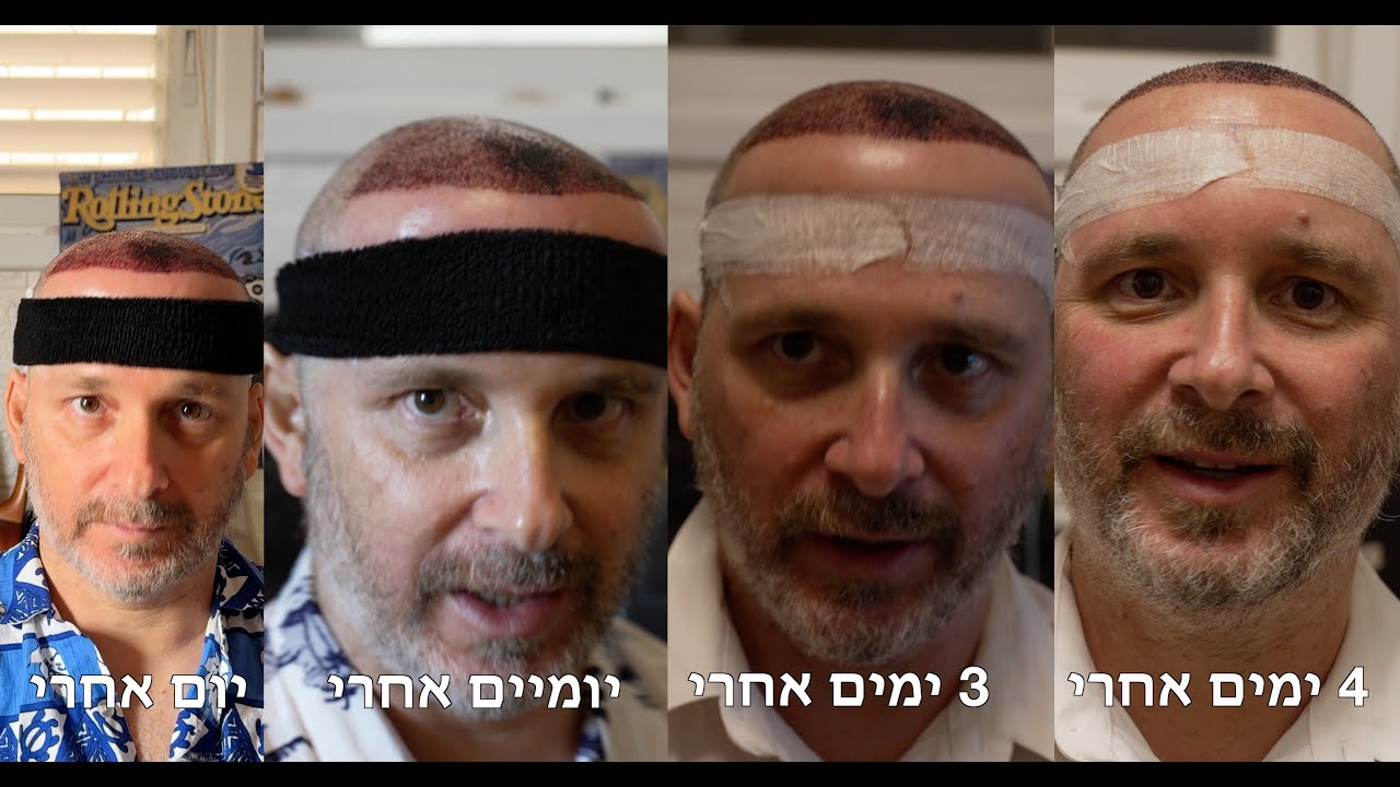 איש הפיל או פיל רגיל   עדכון אחרי השתלת שיער
