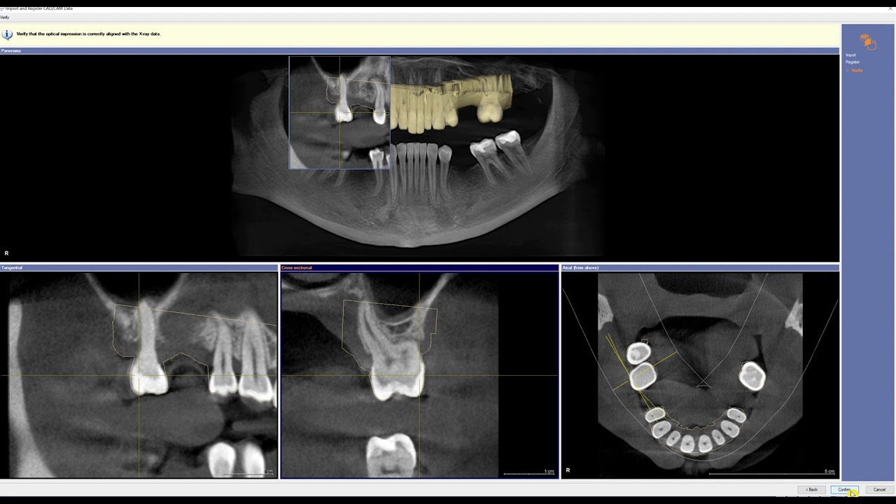 Galaxis Tutorial 6 - Crown Down Implant Planning witrh CEREC SSI
