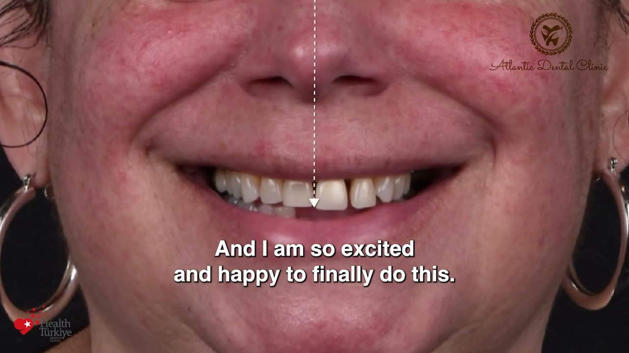 Martha's life changing smile design with 0,4 mm ultra-thin& ultra-strong veneers in Istanbul