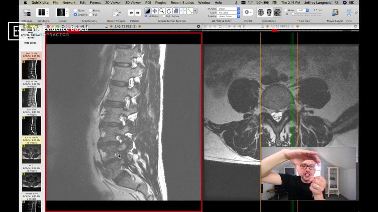 Clinical Series: How to See a Pinched Nerve (Foraminal Stenosis) on MRI