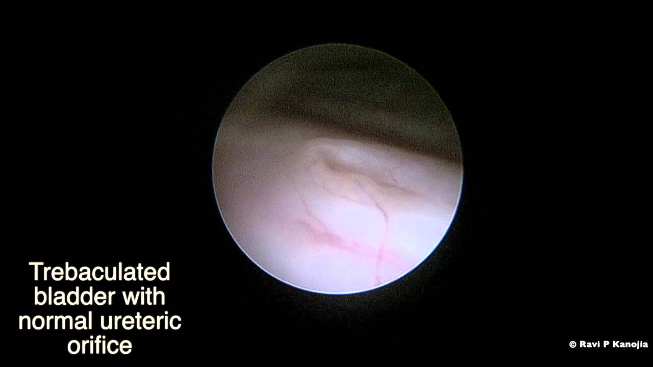 Anterior Urethral Valve