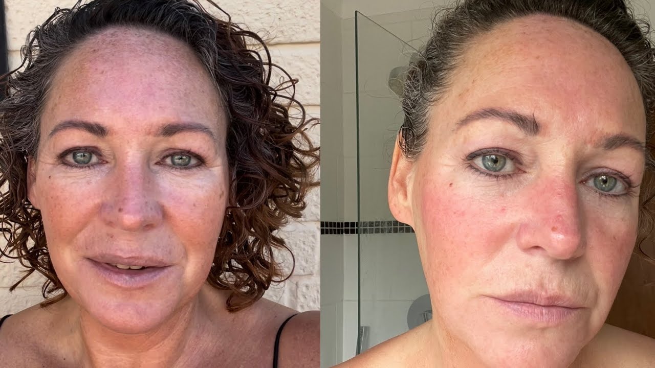 Biorepeel Chemical Peel with Microneedling Before and After