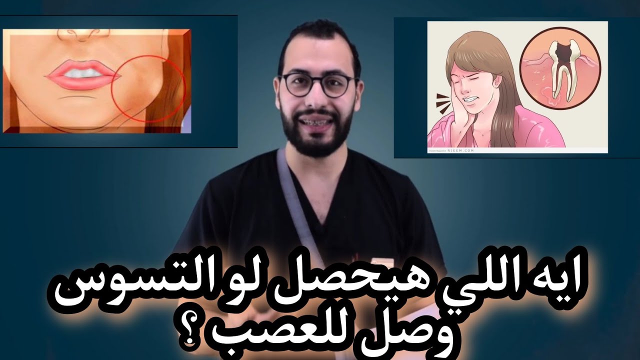 ايه اللي هيحصل لما التسوس يوصل للعصب وايه الحل ؟#التجمع_الخامس #المهندسين #د_عبدالسلام_محمد