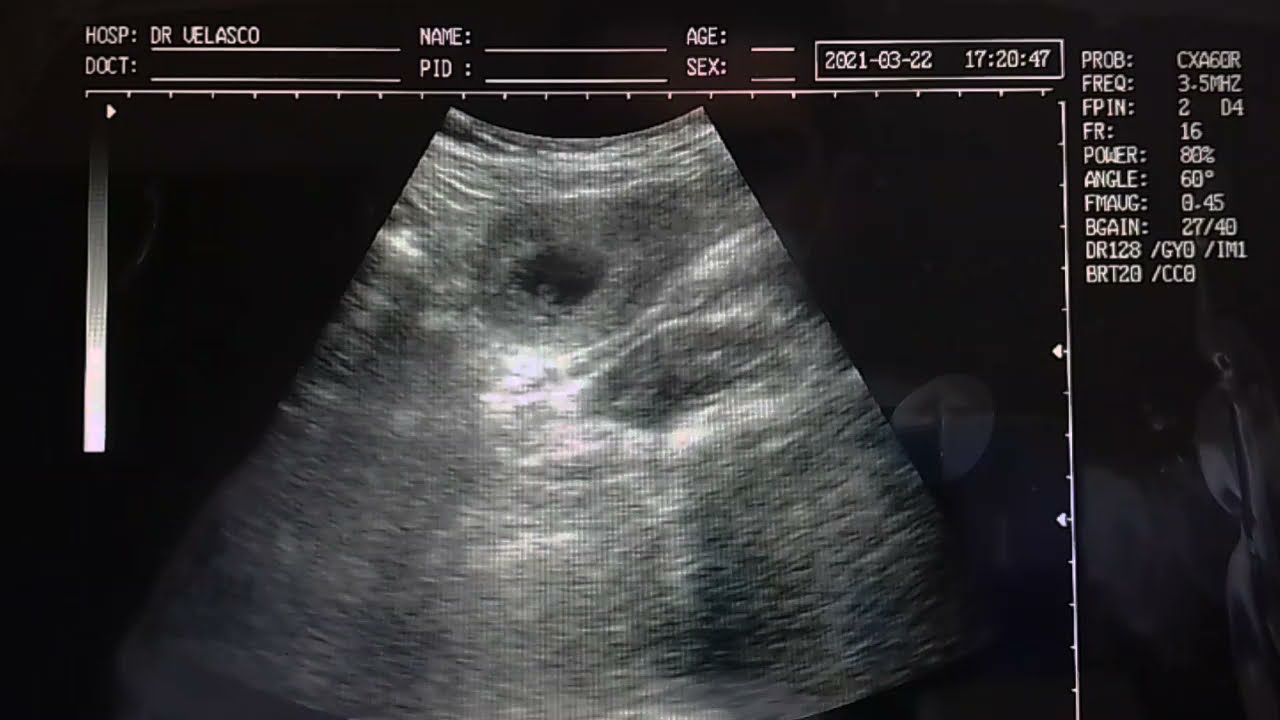 ASÍ SE VE UN EMBARAZO ANEMBRÍONICO DE 6 SEMANAS DE GESTACIÓN