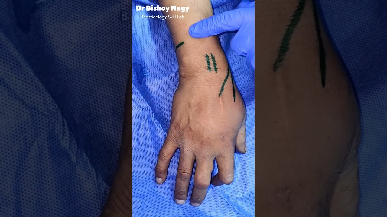 Wrist Block Landmarks - Plasticology Skill Lab