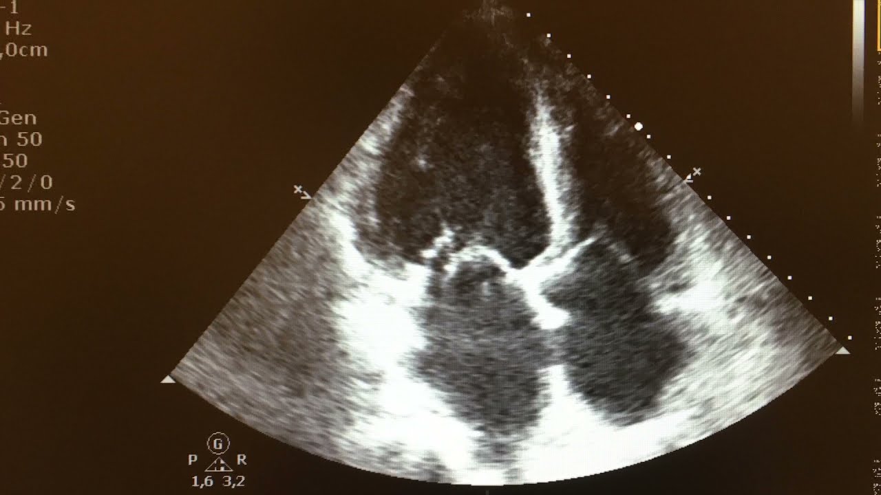 Anterior mitral valve leaflet chordae rupture with severe mitral regurgitation