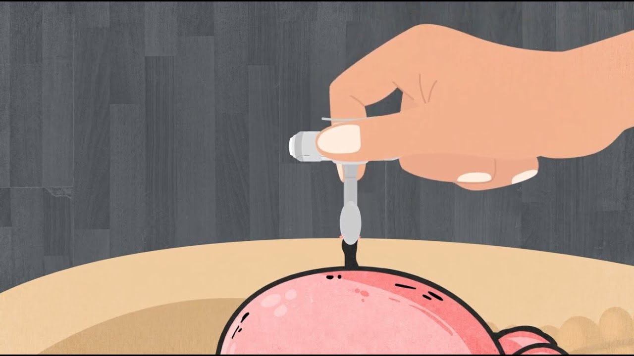 G-Tube - Managing Situations When the G-Tube Comes Out - Stanford Medicine Children's Health