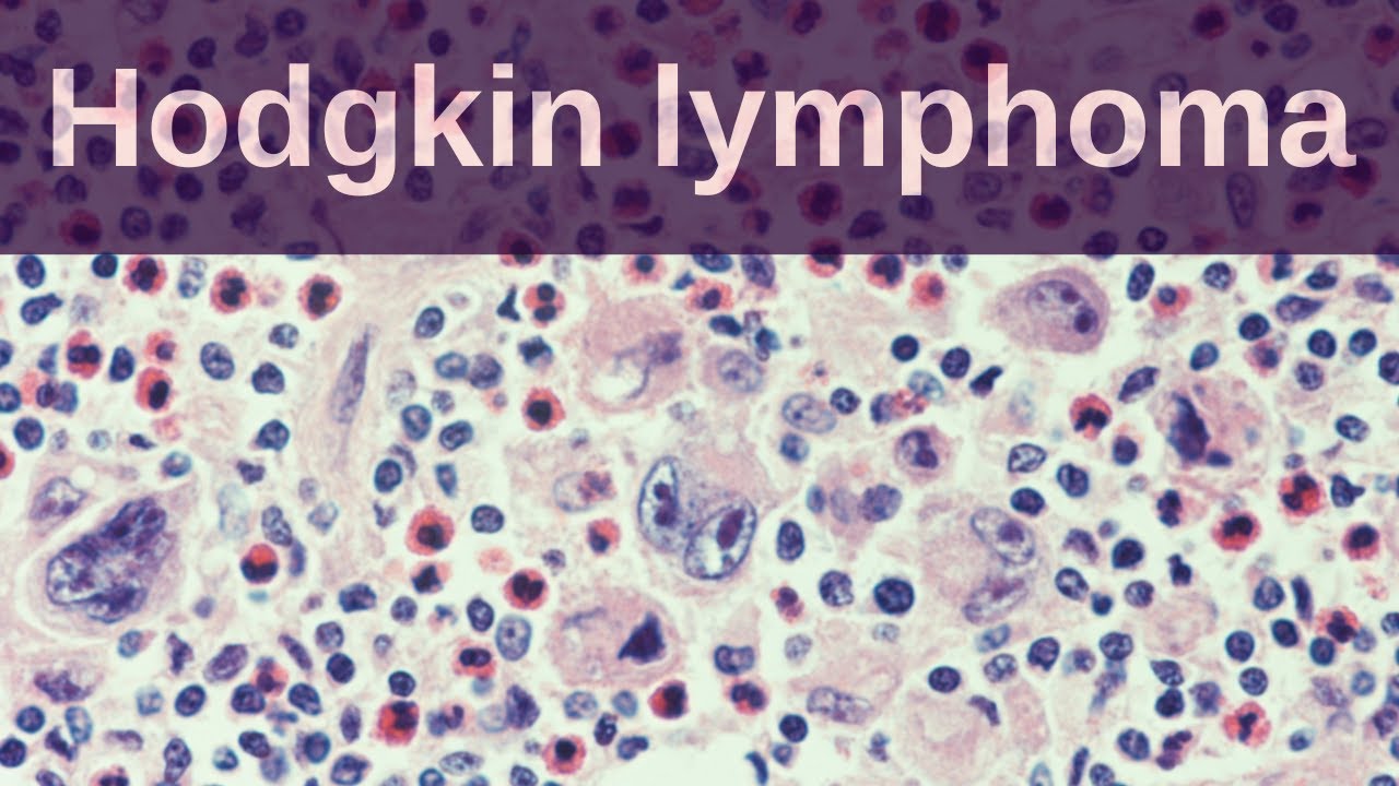 Hodgkin Lymphoma - Pathology mini tutorial