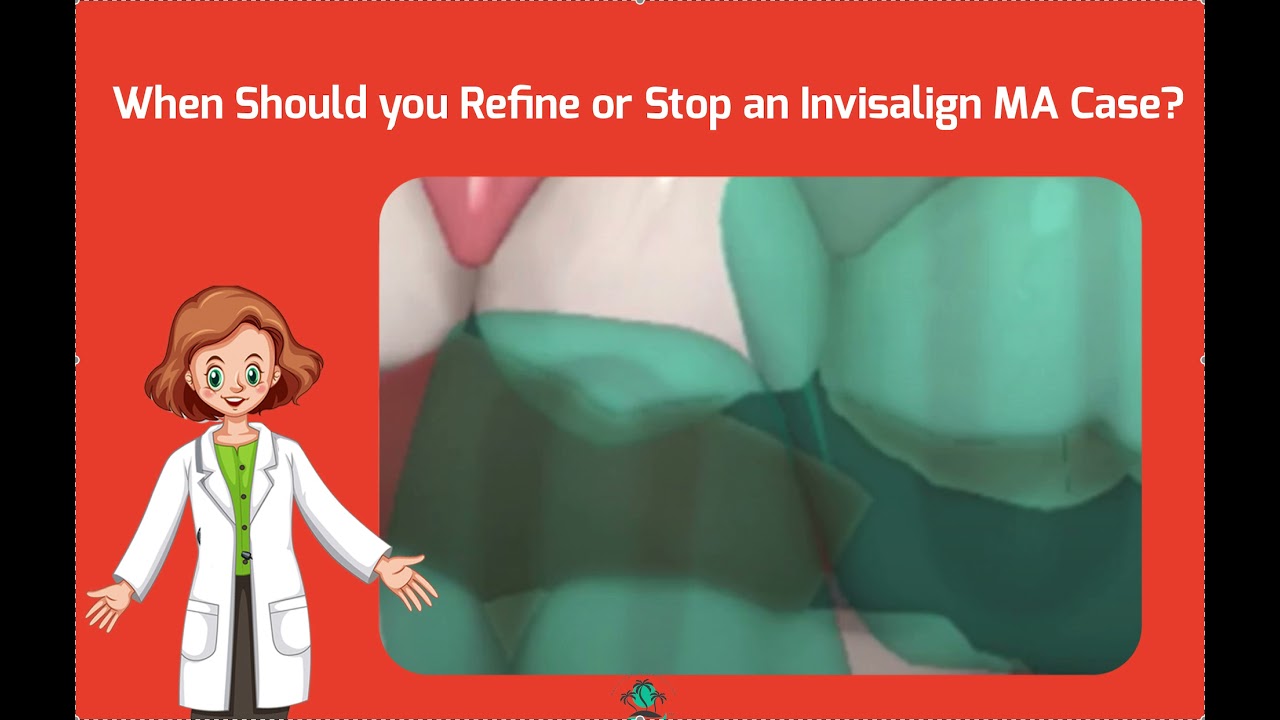 What to do at every Invisalign with MA Appointment? When to Stop MA