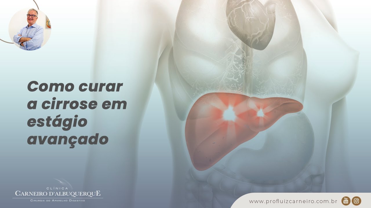 Como curar a cirrose em est&aacute;gio avan&ccedil;ado | Prof. Dr. Luiz Carneiro CRM 22761