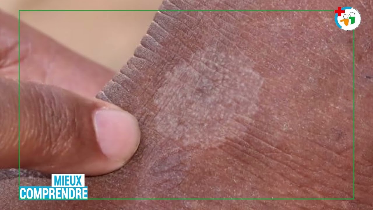 Mieux comprendre la lèpre, maladie tropicale négligée encore présente en Côte d'Ivoire.