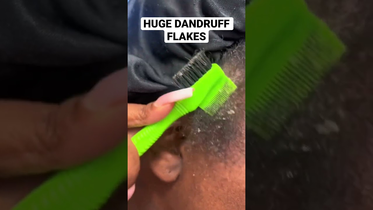 Dandruff scratching ASMR flakes scalp picking psoriasis scratch scales #dandruff #flakes