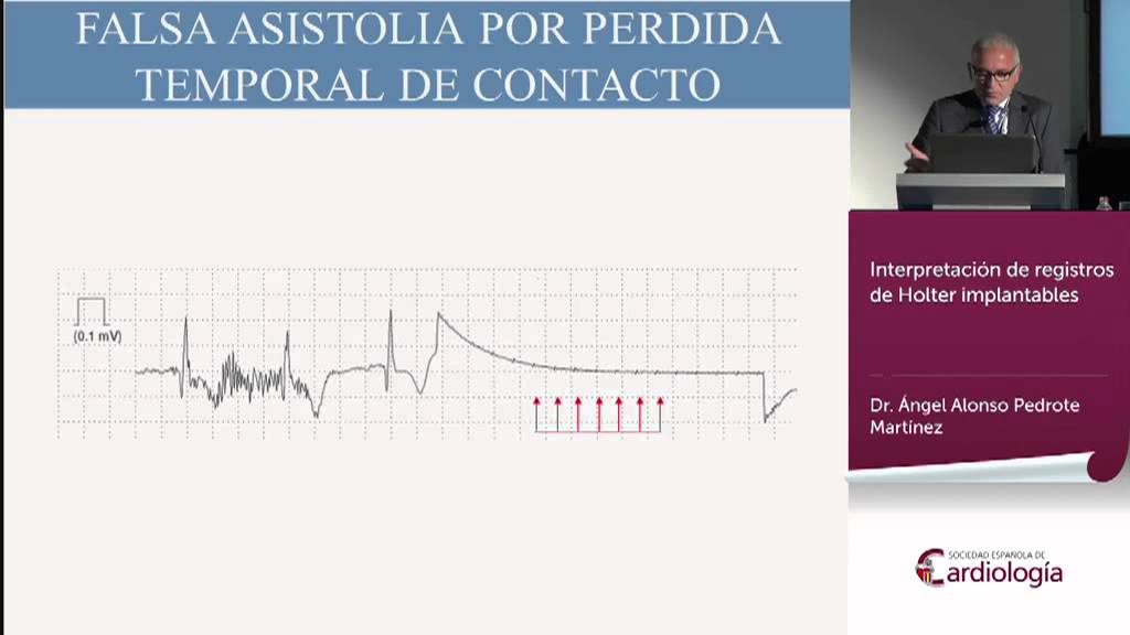 Interpretación de registros de Holter implantables
