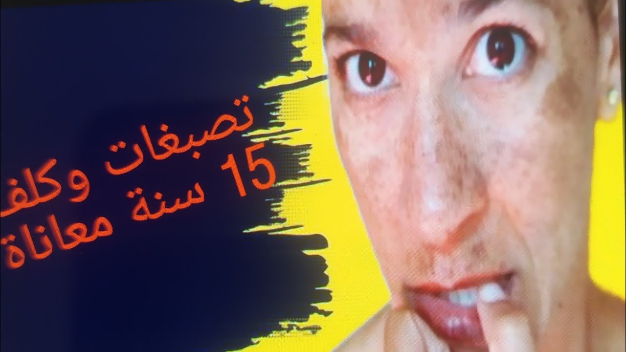شحال د الوقت دوزت للعلاج من الكلف ؟تجربة 15 سنة مابين تصبغات و كلف كيفاش دازت؟تجربتي الشخصية 💪
