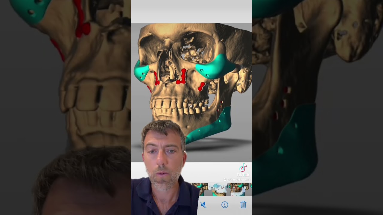 Peek implants as a refinement after double jaw surgery