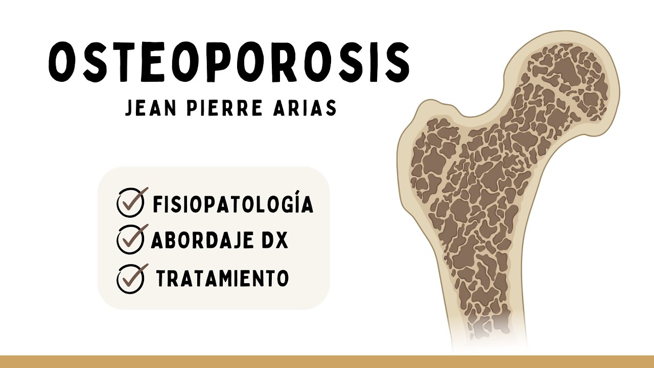 OSTEOPOROSIS: Fisiopatología, Diagnóstico y Tratamiento | Reumatología