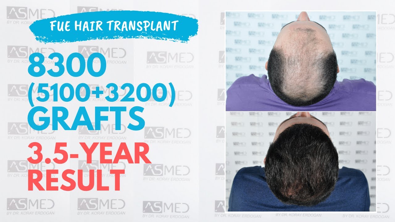 Manual FUE Hair Transplant 8300 (5100+3200) Grafts 3,5-Year Result - ASMED - Dr. Koray Erdogan