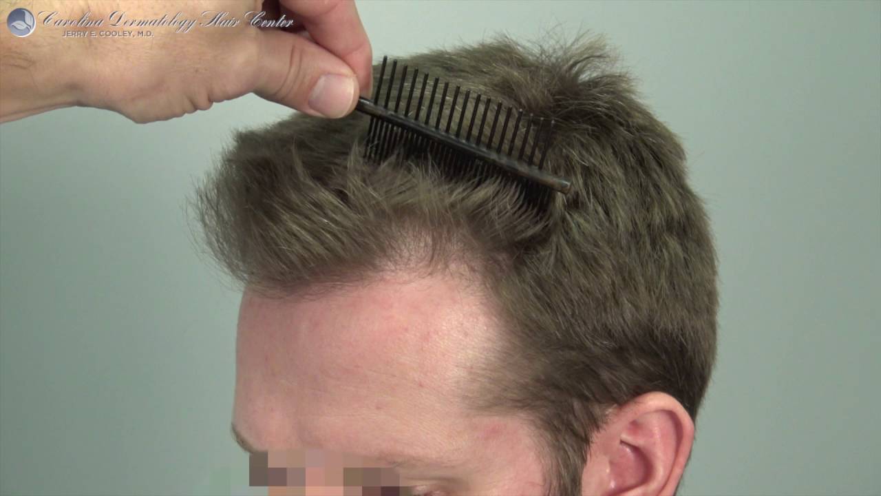 4K Ultra HD Video Jerry Cooley MD 1819 Grafts FUSS