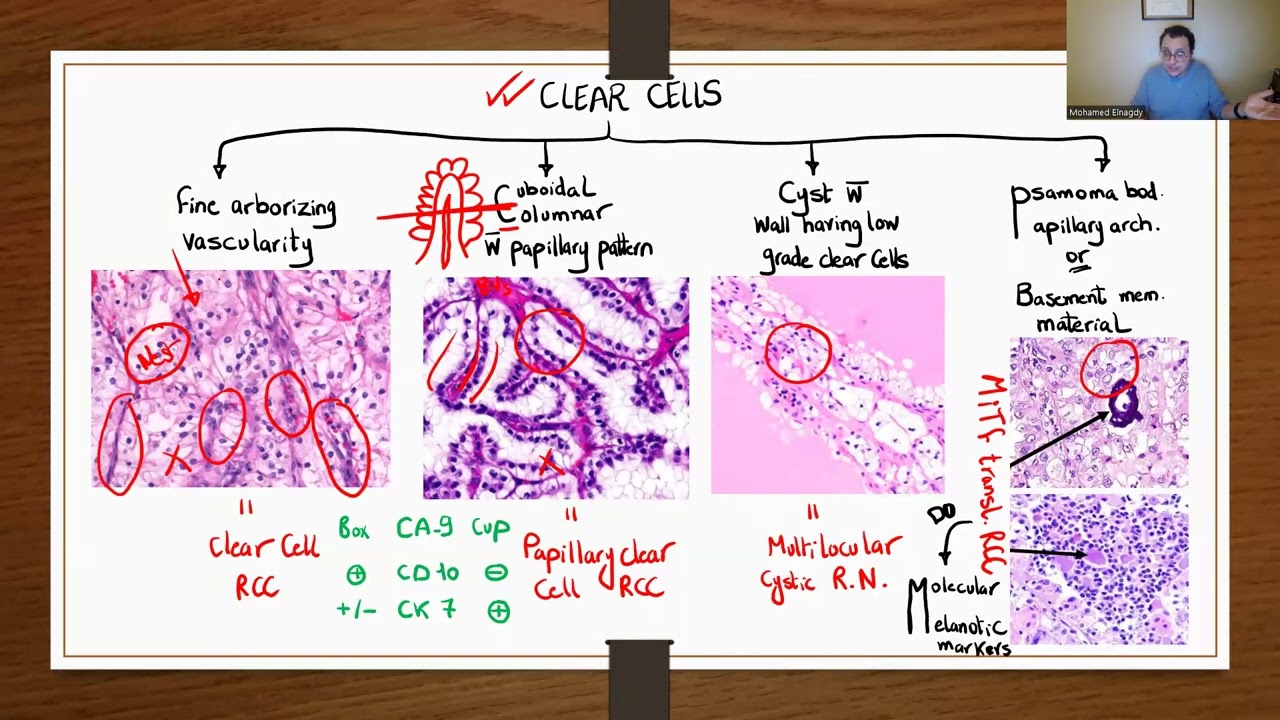 GU PATHOLOGY: RENAL TUMORS 1