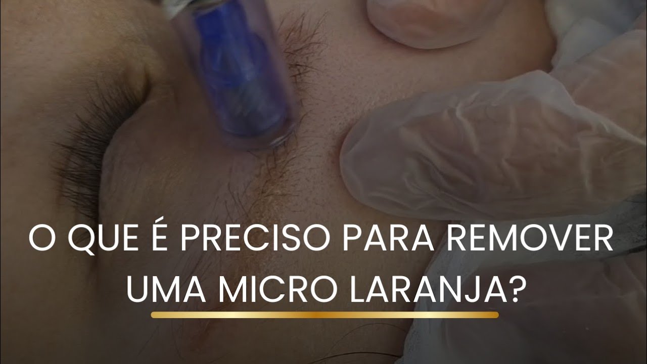 O QUE PRECISO PARA REMOVER UMA MICRO LARANJA? 