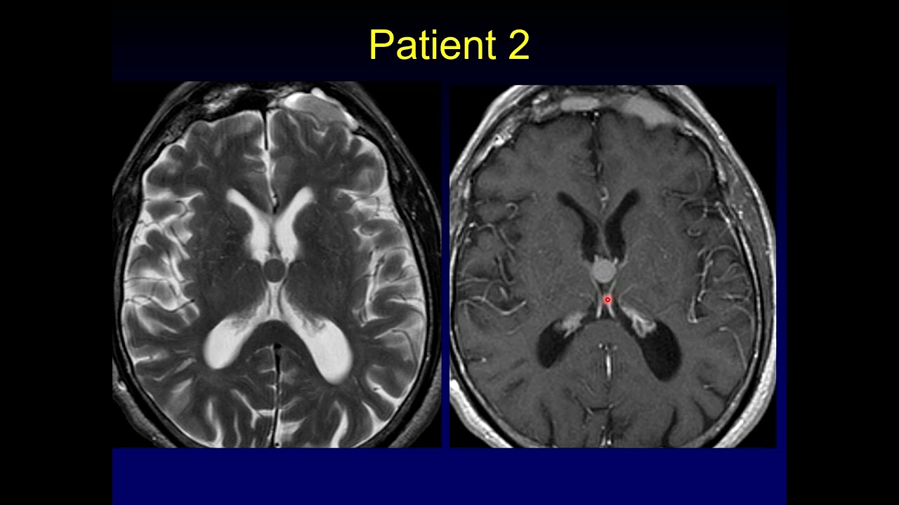 Head to Head:  Third Ventricle Mass
