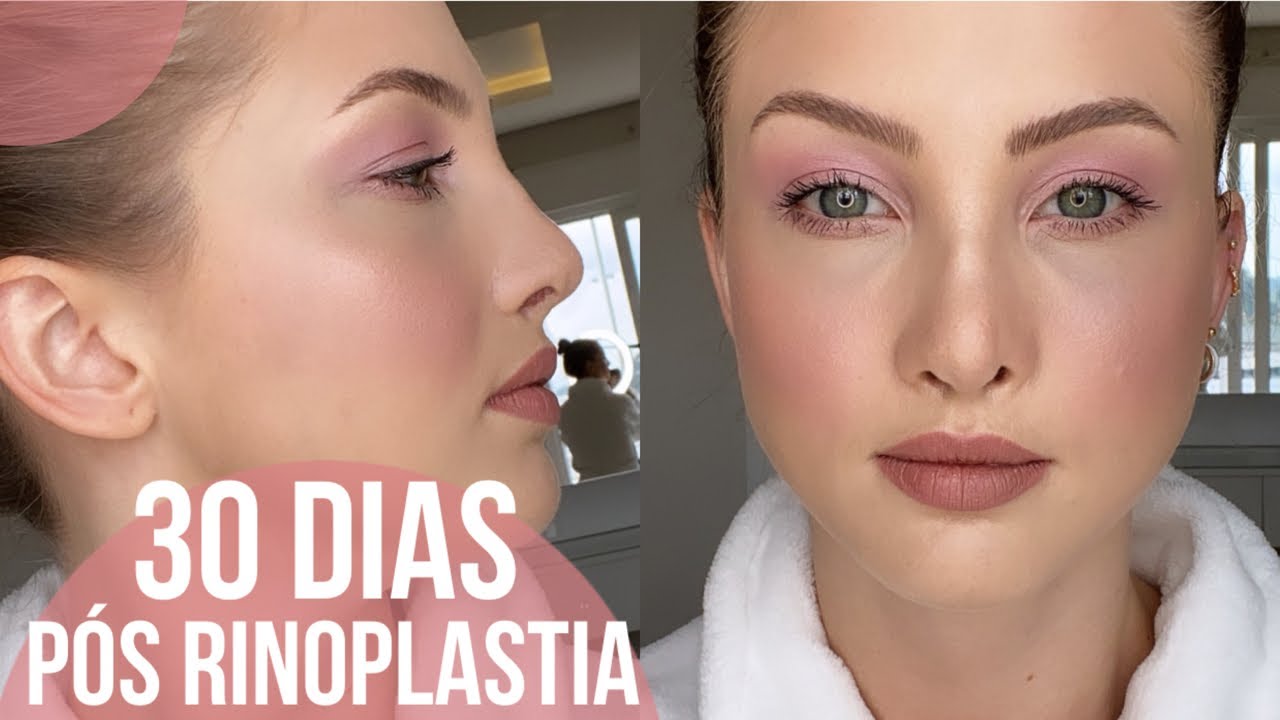 30 dias de RINOPLASTIA | Valeu a pena? 🤭