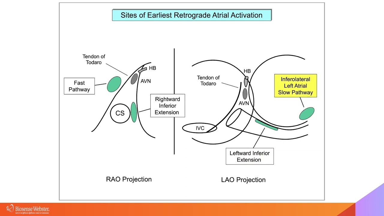 Complex Cases Simplified:  AVNRT Part II with Warren 